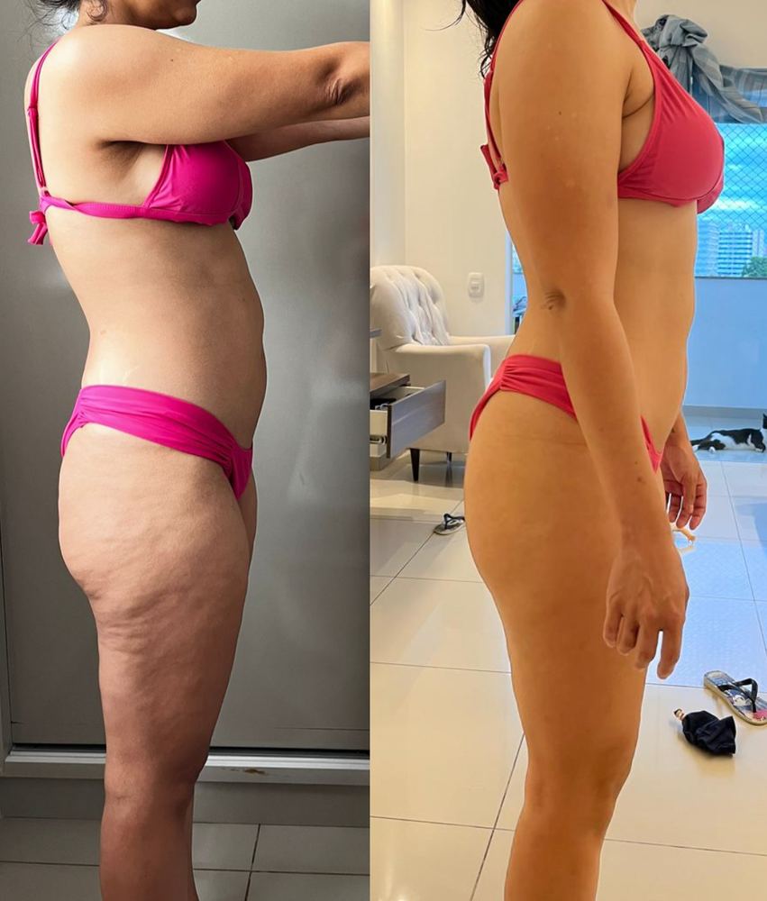 Antes e depois de aluna do Método Queima Extrema